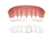 Upper jaw arch with clear retainer below arch, illustration