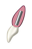 Hybrid titanium dental implant with ceramic crown, illustration
