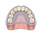 Resorbed edentulous upper jaw with transparent denture, illustration