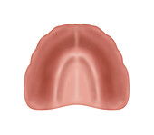 Severely resorbed edentulous upper jaw, illustration