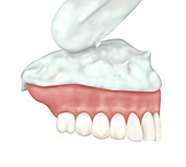 Adding dental plaster for cast into prosthesis, illustration