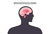 Brainstem glioma, illustration