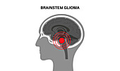 Brainstem glioma, illustration