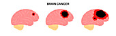 Grades of brain tumours, illustration