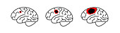 Grades of brain tumours, illustration