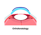 Orthokeratology contact lens, illustration