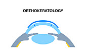 Orthokeratology contact lens, illustration
