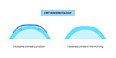 Orthokeratology contact lens, illustration
