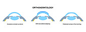 Orthokeratology contact lens, illustration