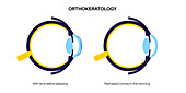 Orthokeratology contact lens, illustration