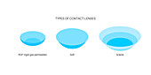 Types of contact lenses, illustration
