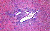 Adenomyosis, light micrograph