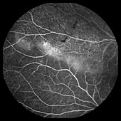 Retinoschisis, angiogram