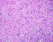 Erythroblastosis fetalis, light micrograph