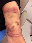 Cutaneous T cell lymphoma