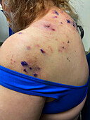 Skin picking disorder