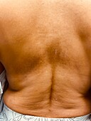 Notalgia paresthetica