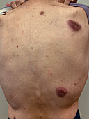 Pyoderma gangrenosum after diverticulitis surgery