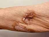 Pyoderma gangrenosum after diverticulitis surgery