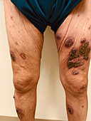 Pyoderma gangrenosum after diverticulitis surgery