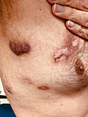 Pyoderma gangrenosum after diverticulitis surgery