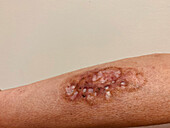 Pyoderma gangrenosum after diverticulitis surgery