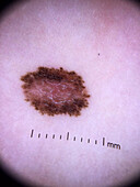 Reed nevus, dermoscopy
