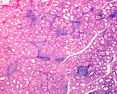 Chronic thyroiditis, light micrograph