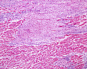 Ischemic infarct of heart myocardium, light micrograph