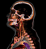 Atherosclerosis, 3D CT scan