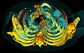 Lungs affected by Covid-19 pneumonia, 3D CT scan