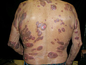Cutaneous T cell lymphoma
