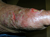 Cutaneous T cell lymphoma