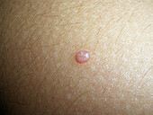 Molluscum contagiosum