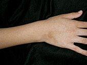 Phytophotodermatitis