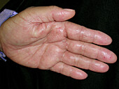 Hyperlinear palm in atopic dermatitis