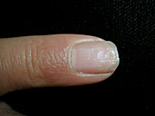 Psoriasis during treatment