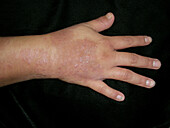 Psoriasis during treatment