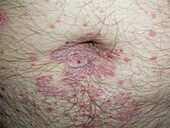 Inverse psoriasis