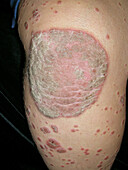Psoriasis