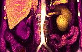 Renal artery thrombosis, 3D CT scan