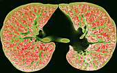 Healthy lungs, 3D CT scan