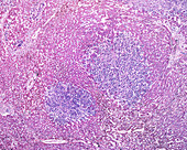 Human liver carcinoma, light micrograph