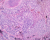 Human liver carcinoma, light micrograph