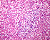 Human liver cholangiocarcinoma, light micrograph