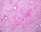 Human fatty liver, light micrograph