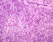 Pneumonia, light micrograph