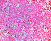 Toxic liver disease, light micrograph