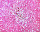 Toxic liver disease, light micrograph