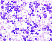 Chronic myeloid leukaemia, light micrograph
